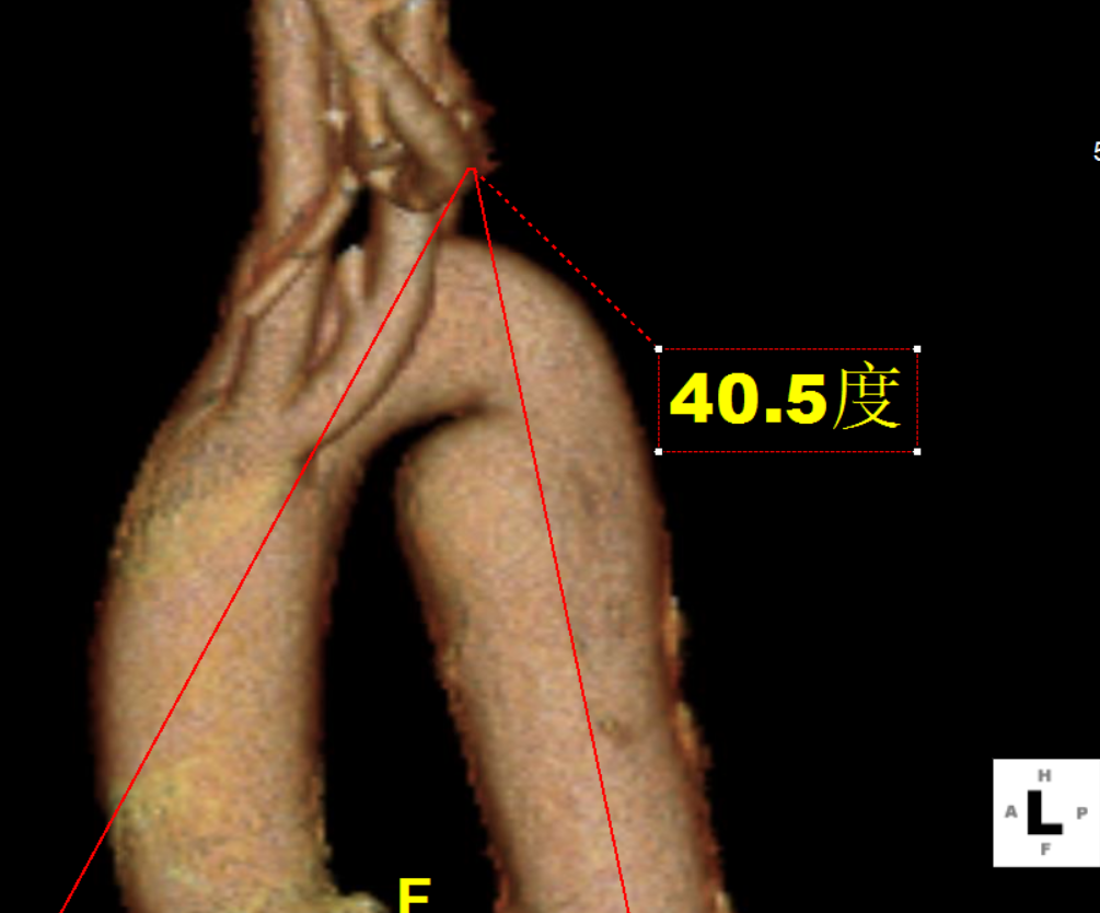 gore医疗怎么样「胸有乾坤」可调可控，从容不迫——GORE® TAG®可主动调控胸主动脉覆膜支架治疗右弓右降伴Kommerell憩室病例_https://www.jmylbn.com_新闻资讯_第8张