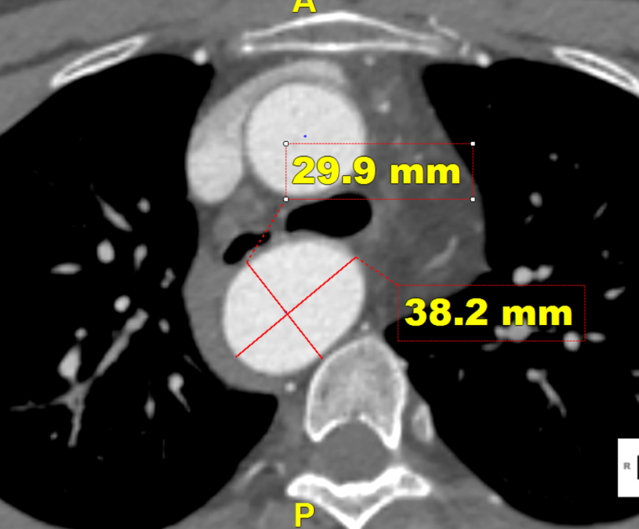 gore医疗怎么样「胸有乾坤」可调可控，从容不迫——GORE® TAG®可主动调控胸主动脉覆膜支架治疗右弓右降伴Kommerell憩室病例_https://www.jmylbn.com_新闻资讯_第9张