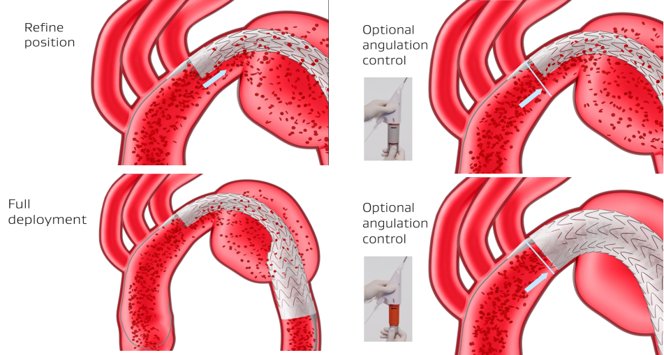 gore医疗怎么样「胸有乾坤」可调可控，从容不迫——GORE® TAG®可主动调控胸主动脉覆膜支架治疗右弓右降伴Kommerell憩室病例_https://www.jmylbn.com_新闻资讯_第12张
