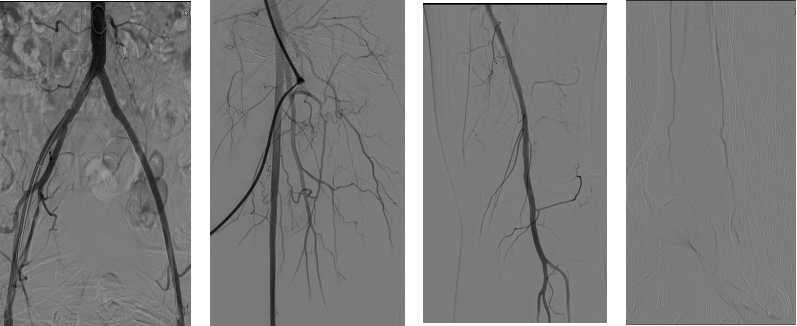 gore医疗怎么样【戈调·髂到好处】GORE VIABAHN VBX 球囊扩张血管内覆膜支架联合VIABAHN治疗长段髂动脉闭塞性病变的探索_https://www.jmylbn.com_新闻资讯_第13张