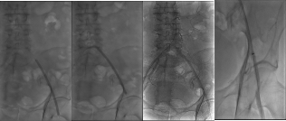 gore医疗怎么样【戈调·髂到好处】GORE VIABAHN VBX 球囊扩张血管内覆膜支架联合VIABAHN治疗长段髂动脉闭塞性病变的探索_https://www.jmylbn.com_新闻资讯_第7张