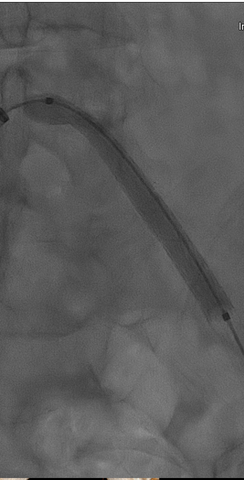 gore医疗怎么样【戈调·髂到好处】GORE VIABAHN VBX 球囊扩张血管内覆膜支架联合VIABAHN治疗长段髂动脉闭塞性病变的探索_https://www.jmylbn.com_新闻资讯_第10张