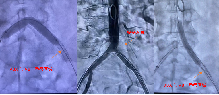 gore医疗怎么样【戈调·髂到好处】GORE VIABAHN VBX 球囊扩张血管内覆膜支架联合VIABAHN治疗长段髂动脉闭塞性病变的探索_https://www.jmylbn.com_新闻资讯_第11张