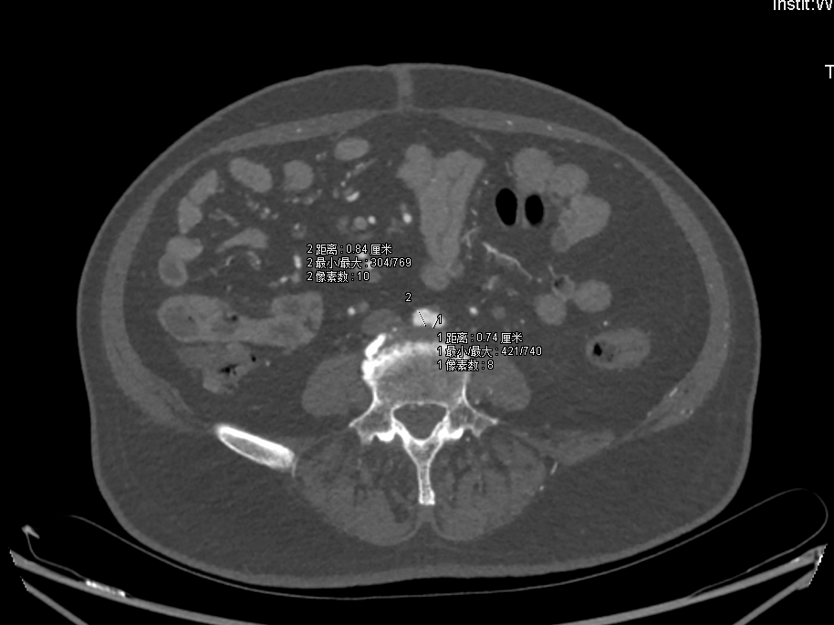gore医疗怎么样【戈调·髂到好处】GORE VIABAHN VBX 球囊扩张血管内覆膜支架联合VIABAHN治疗长段髂动脉闭塞性病变的探索_https://www.jmylbn.com_新闻资讯_第4张