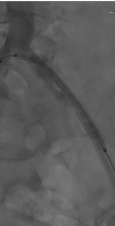 gore医疗怎么样【戈调·髂到好处】GORE VIABAHN VBX 球囊扩张血管内覆膜支架联合VIABAHN治疗长段髂动脉闭塞性病变的探索_https://www.jmylbn.com_新闻资讯_第9张
