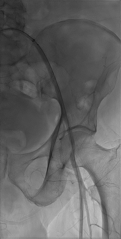 gore医疗怎么样【戈调·髂到好处】GORE VIABAHN VBX 球囊扩张血管内覆膜支架联合VIABAHN治疗长段髂动脉闭塞性病变的探索_https://www.jmylbn.com_新闻资讯_第8张