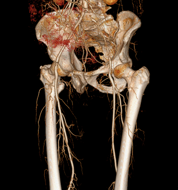gore医疗怎么样【戈调·髂到好处】GORE VIABAHN VBX 球囊扩张血管内覆膜支架联合VIABAHN治疗长段髂动脉闭塞性病变的探索_https://www.jmylbn.com_新闻资讯_第5张