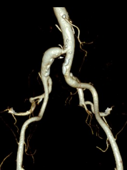 导丝怎么扩【问术ASK】佟铸教授：双侧髂总动脉“对吻”球扩覆膜支架植入术_https://www.jmylbn.com_新闻资讯_第3张