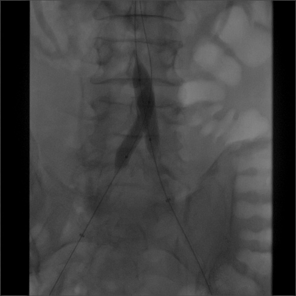 导丝怎么扩【问术ASK】佟铸教授：双侧髂总动脉“对吻”球扩覆膜支架植入术_https://www.jmylbn.com_新闻资讯_第9张