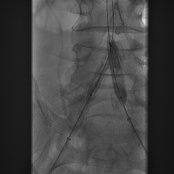 导丝怎么扩【问术ASK】佟铸教授：双侧髂总动脉“对吻”球扩覆膜支架植入术_https://www.jmylbn.com_新闻资讯_第8张