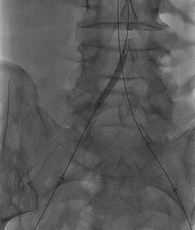 导丝怎么扩【问术ASK】佟铸教授：双侧髂总动脉“对吻”球扩覆膜支架植入术_https://www.jmylbn.com_新闻资讯_第5张