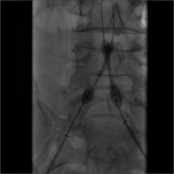 导丝怎么扩【问术ASK】佟铸教授：双侧髂总动脉“对吻”球扩覆膜支架植入术_https://www.jmylbn.com_新闻资讯_第7张