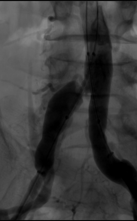 导丝怎么扩【问术ASK】佟铸教授：双侧髂总动脉“对吻”球扩覆膜支架植入术_https://www.jmylbn.com_新闻资讯_第6张