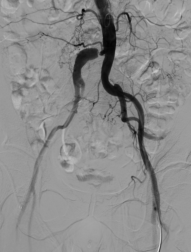 导丝怎么扩【问术ASK】佟铸教授：双侧髂总动脉“对吻”球扩覆膜支架植入术_https://www.jmylbn.com_新闻资讯_第4张