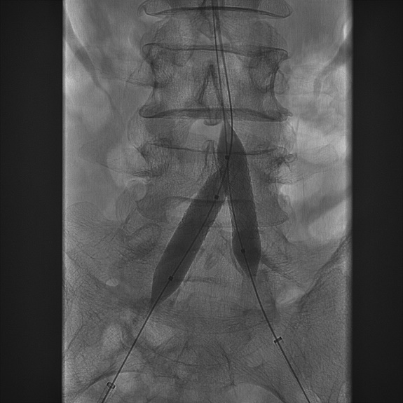 导丝怎么扩【问术ASK】佟铸教授：双侧髂总动脉“对吻”球扩覆膜支架植入术_https://www.jmylbn.com_新闻资讯_第10张