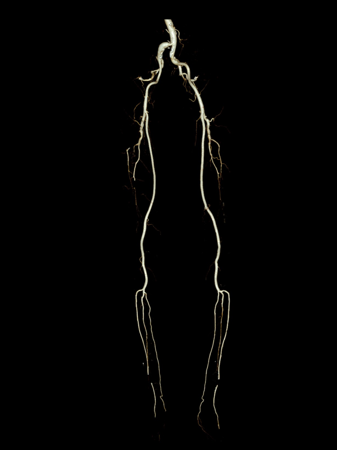 导丝怎么扩【问术ASK】佟铸教授：双侧髂总动脉“对吻”球扩覆膜支架植入术_https://www.jmylbn.com_新闻资讯_第2张