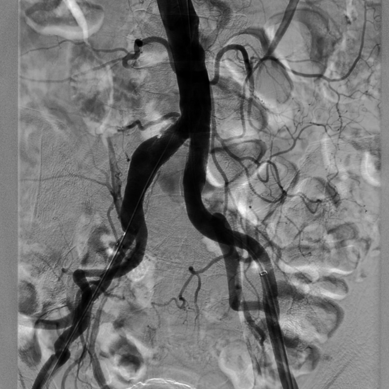 导丝怎么扩【问术ASK】佟铸教授：双侧髂总动脉“对吻”球扩覆膜支架植入术_https://www.jmylbn.com_新闻资讯_第11张