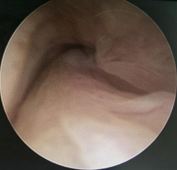 宫内镜怎么进入子宫小镜子  大用途——宫腔镜阴道内镜技术为未婚女性解忧_https://www.jmylbn.com_新闻资讯_第2张