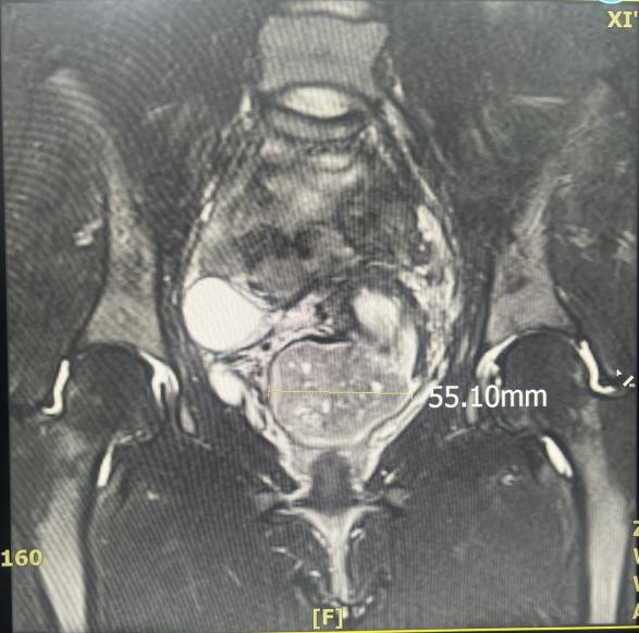 宫内镜怎么进入子宫小镜子  大用途——宫腔镜阴道内镜技术为未婚女性解忧_https://www.jmylbn.com_新闻资讯_第1张