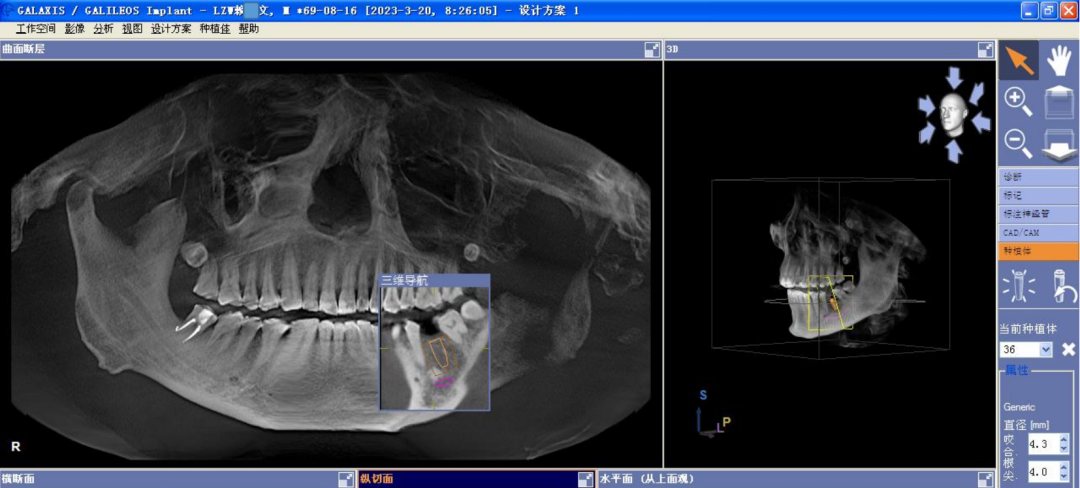 颊舌向宽度约7-8mm,骨质正常,无疏松影,35根尖远中见一"骨岛"影像