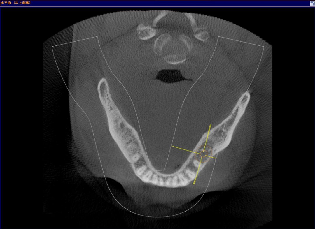 颊舌向宽度约7-8mm,骨质正常,无疏松影,35根尖远中见一"骨岛"影像