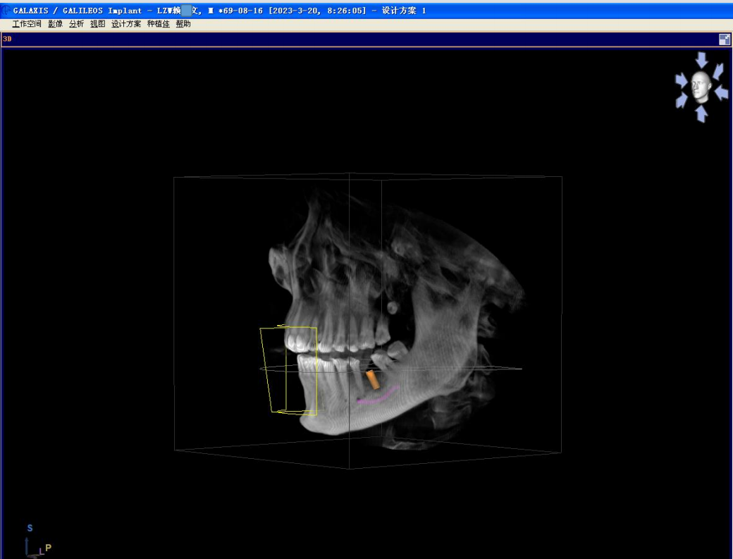 颊舌向宽度约7-8mm,骨质正常,无疏松影,35根尖远中见一"骨岛"影像