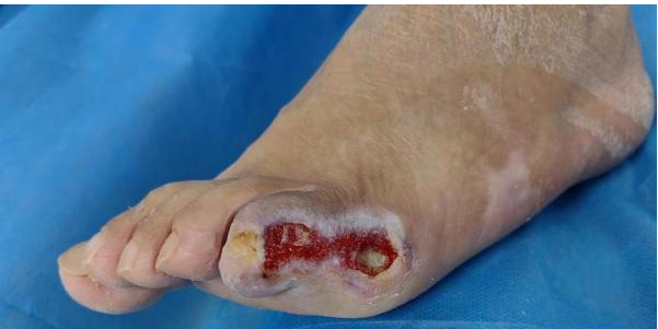 为什么负压引流负压封闭引流术（VSD） 糖尿病足溃疡患者的福音_https://www.jmylbn.com_新闻资讯_第9张