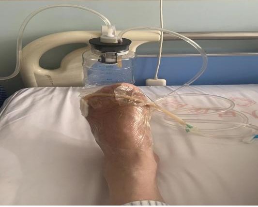 为什么负压引流负压封闭引流术（VSD） 糖尿病足溃疡患者的福音_https://www.jmylbn.com_新闻资讯_第4张