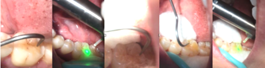 口腔激光怎么治疗激光治疗，点亮口腔健康_https://www.jmylbn.com_新闻资讯_第3张