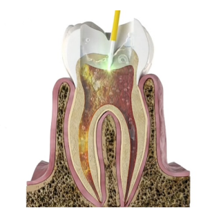 口腔激光怎么治疗激光治疗，点亮口腔健康_https://www.jmylbn.com_新闻资讯_第4张