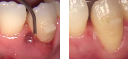 口腔激光怎么治疗激光治疗，点亮口腔健康_https://www.jmylbn.com_新闻资讯_第5张