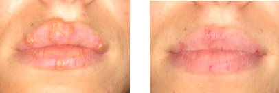 口腔激光怎么治疗激光治疗，点亮口腔健康_https://www.jmylbn.com_新闻资讯_第6张