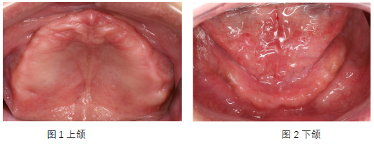 口腔吸盘怎么安装像“吸盘”一样的吸附性义齿——无牙𬌗的福音!_新闻资讯_第3张_活检穿刺产品网 口腔吸盘怎么安装像“吸盘”一样的吸附性义齿——无牙𬌗的福音!_https://www.jmylbn.com_新闻资讯_第3张