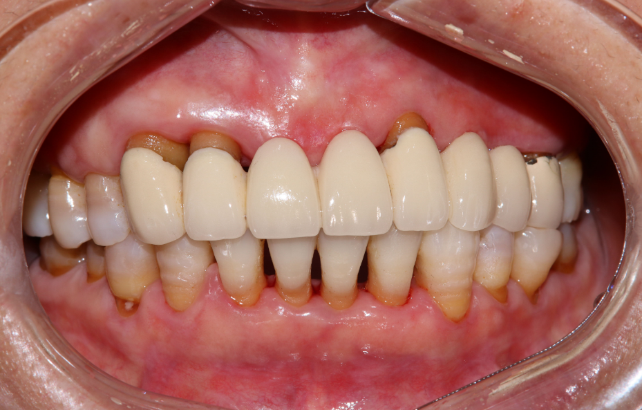 口腔内窥镜怎么用牙周内窥镜，呵护口腔健康_https://www.jmylbn.com_新闻资讯_第12张