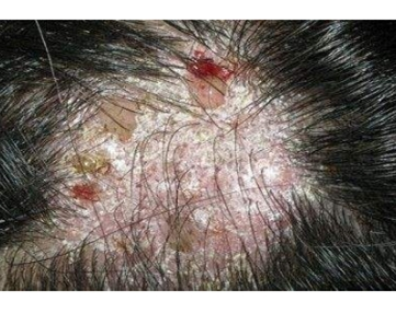 头癣是怎么回事，头皮上有癣怎么办