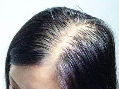 额头处脱发严重怎么回事，学生防脱发的方法有哪些