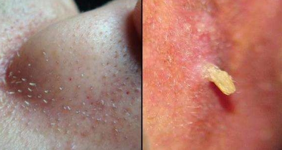 女性私处毛囊炎怎么引起的，毛囊炎怎么能治好