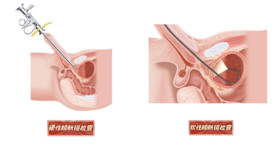 b膀胱镜为什么消毒无痛膀胱镜——告别酸爽，一“探”究竟_https://www.jmylbn.com_新闻资讯_第1张