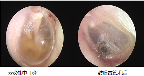 耳朵内窥镜什么样【红旗科普】一文读懂 ｜ 耳内窥镜可以做哪些检查？_https://www.jmylbn.com_新闻资讯_第19张