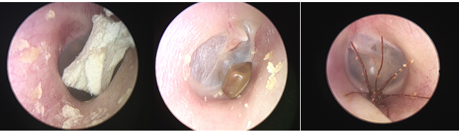 耳朵内窥镜什么样【红旗科普】一文读懂 ｜ 耳内窥镜可以做哪些检查？_https://www.jmylbn.com_新闻资讯_第13张