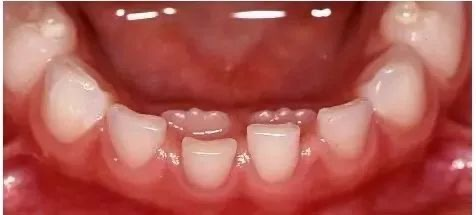 曲面断层片怎么看换牙与身高有关吗？关于孩子换牙的所有疑问一篇说清_https://www.jmylbn.com_新闻资讯_第15张