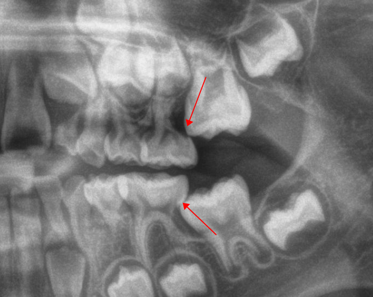 曲面断层片怎么看换牙与身高有关吗？关于孩子换牙的所有疑问一篇说清_https://www.jmylbn.com_新闻资讯_第22张