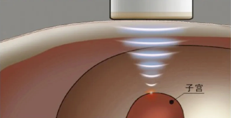 产后康复治疗仪怎么用乌沙医院引进超声子宫复旧治疗仪：让TA恢复如初 重现女性光彩_https://www.jmylbn.com_新闻资讯_第18张