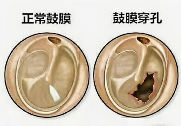 耳朵内窥镜什么样耳朵检查：用“放大镜”揪出隐藏的“小坏蛋”_https://www.jmylbn.com_新闻资讯_第8张