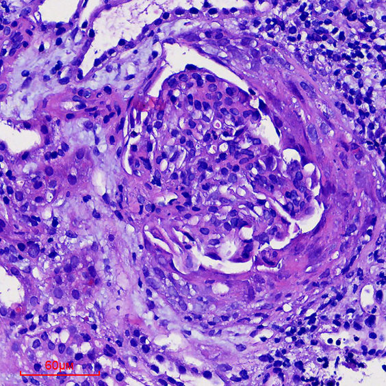医讯怎么用『附一医讯』乱用偏方致过敏，女子急性肾衰竭！福建医大附一医院肾内科“换血救肾”_https://www.jmylbn.com_新闻资讯_第9张