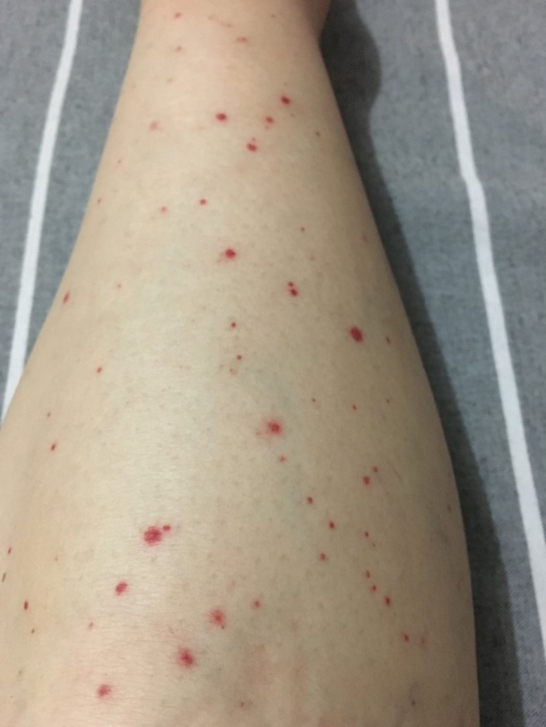 医讯怎么用『附一医讯』乱用偏方致过敏，女子急性肾衰竭！福建医大附一医院肾内科“换血救肾”_https://www.jmylbn.com_新闻资讯_第5张