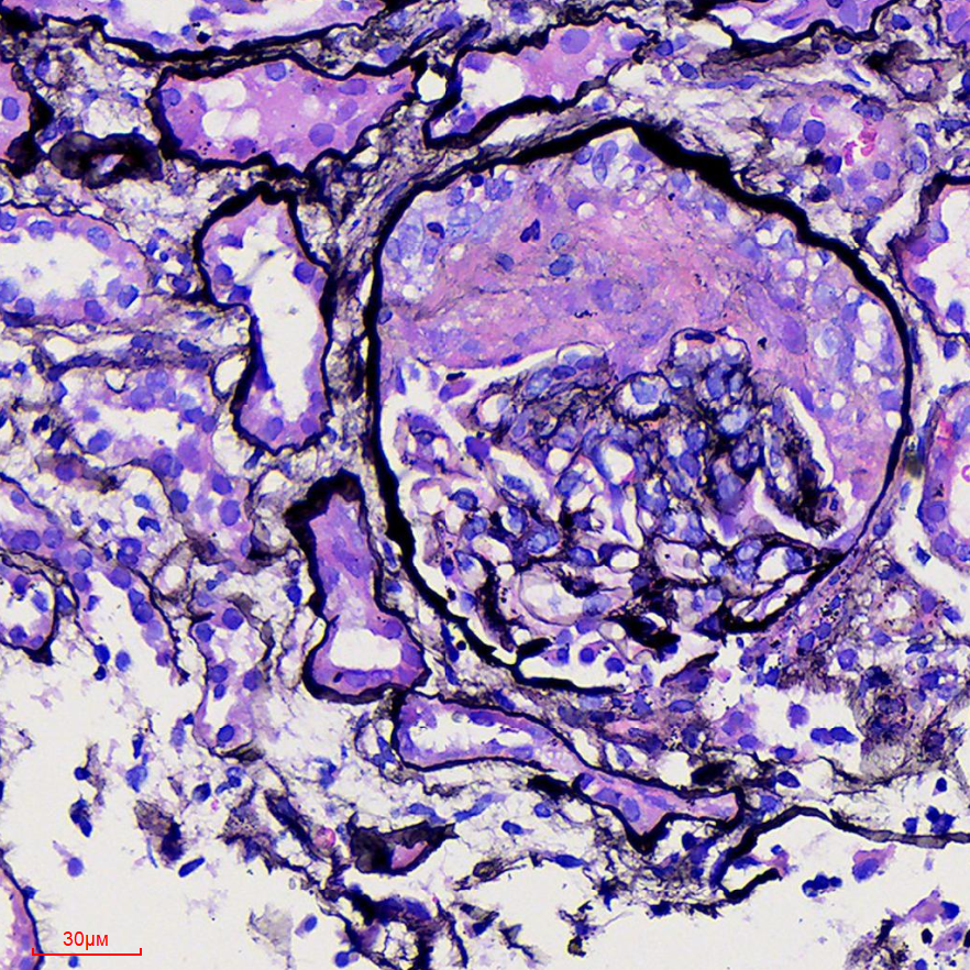 医讯怎么用『附一医讯』乱用偏方致过敏，女子急性肾衰竭！福建医大附一医院肾内科“换血救肾”_https://www.jmylbn.com_新闻资讯_第8张