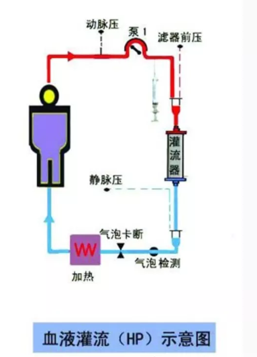 医讯怎么用『附一医讯』高脂血症性胰腺炎治疗“神器”再显神威！我院EICU使用血液灌流治疗，让多名危重患者度过难关_https://www.jmylbn.com_新闻资讯_第8张