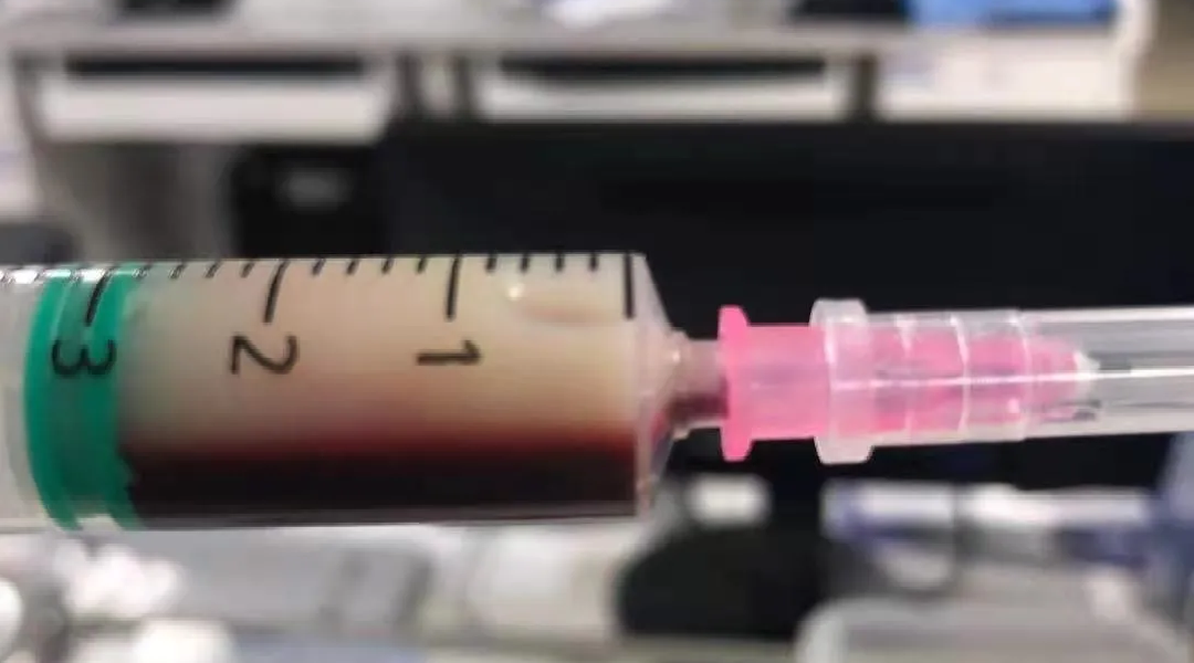 医讯怎么用『附一医讯』高脂血症性胰腺炎治疗“神器”再显神威！我院EICU使用血液灌流治疗，让多名危重患者度过难关_https://www.jmylbn.com_新闻资讯_第5张