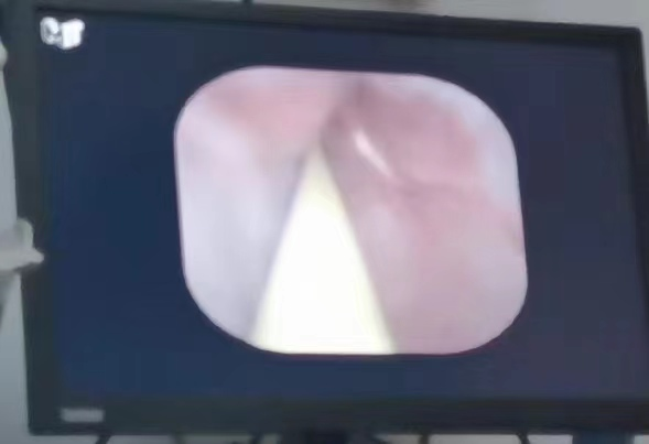 斑马导丝是治疗什么的【新技术】阑尾炎也可以不开刀：全市首例内镜逆行性阑尾炎治疗术（ERAT）+阑尾子镜+阑尾支架置入术_https://www.jmylbn.com_新闻资讯_第6张